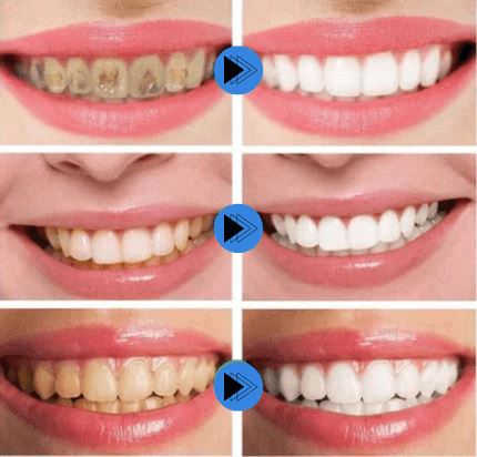 Caneta Clareadora Dental Instantânea - Ideal para Quem Busca um Sorriso Branco e Radiante
